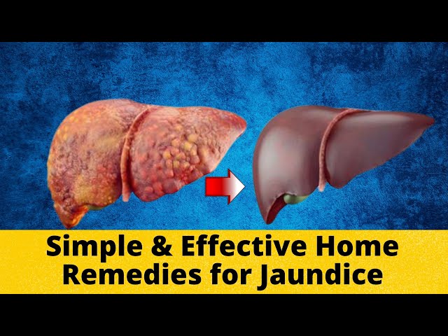 Top 10 Natural Remedies for Jaundice | Safe & Effective (2025)